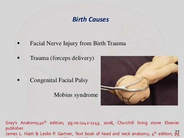 Facial palsy forcep delivery Swinger club miami florida